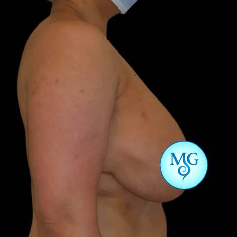 Reducción Mamaria Antes - caso 1, perfil derecho - Dr. Gil Miranda Buenos Aires