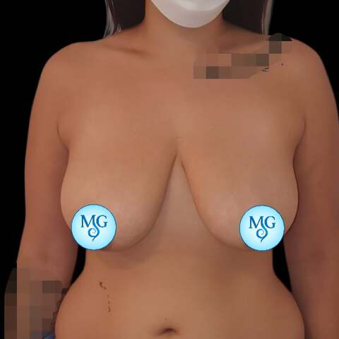 Reducción Mamaria Antes - caso 2, vista de frente - Dr. Gil Miranda Buenos Aires