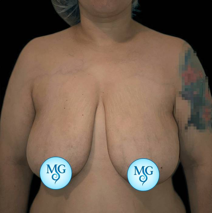 Reducción Mamaria Antes - caso 3, vista de frente - Dr. Gil Miranda Buenos Aires