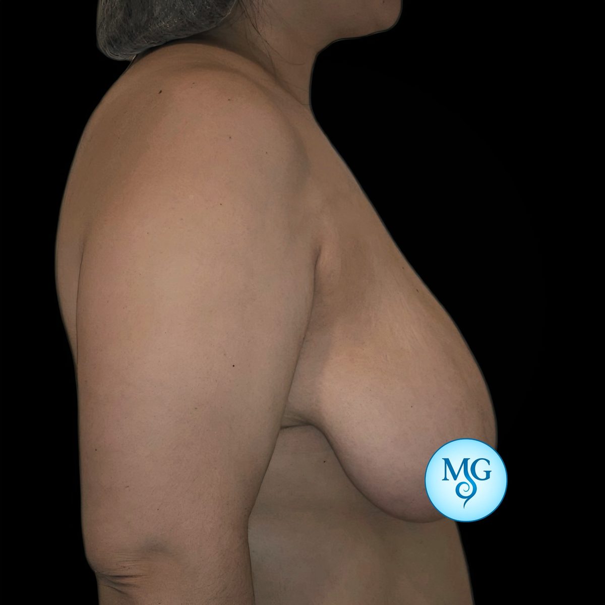 Reducción Mamaria Antes - caso 3, perfil derecho - Dr. Gil Miranda Buenos Aires